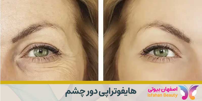 هایفوتراپی دور چشم