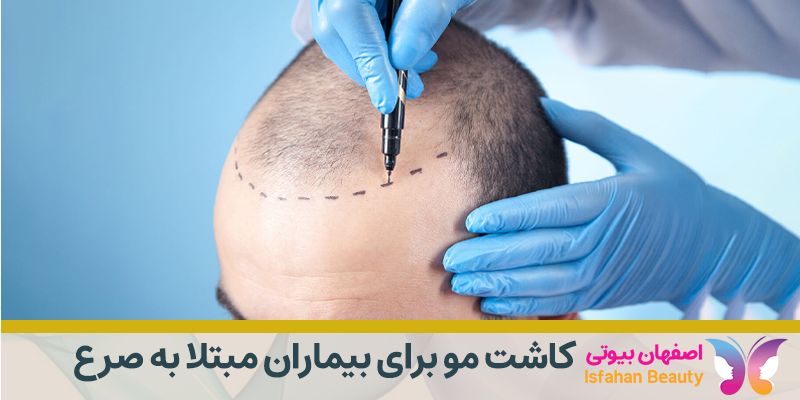کاشت مو برای بیماران مبتلا به صرع