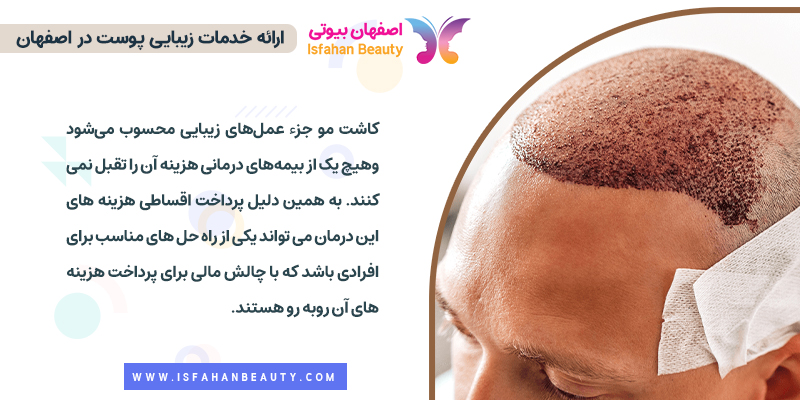 کاشت مو اقساطی با وام و چک در اصفهان