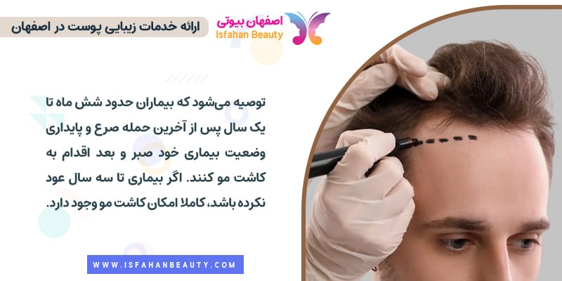 شرایط کاشت مو برای بیماران مبتلا به صرع