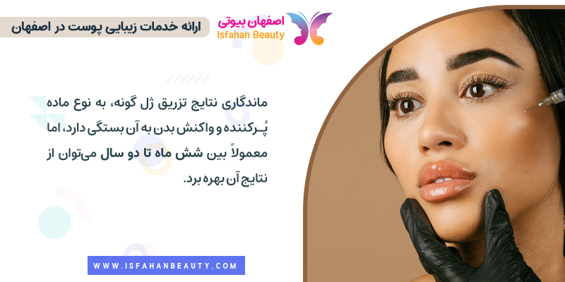 ماندگاری تزریق ژل گونه