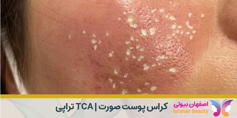 کراس پوست صورت | TCA تراپی