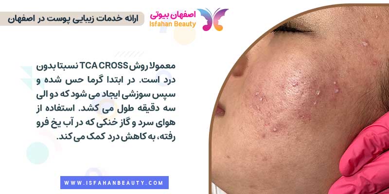 آیا انجام TCA cross درد دارد؟