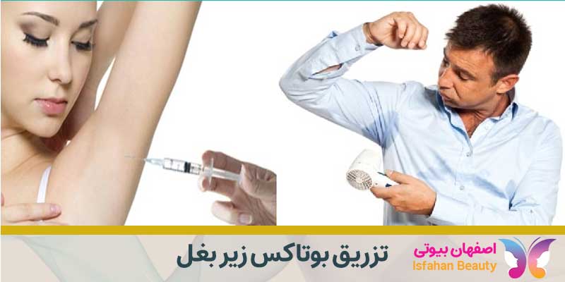 تزریق بوتاکس زیر بغل در اصفهان|درمان هایپرهیدروزیس زیر بغل