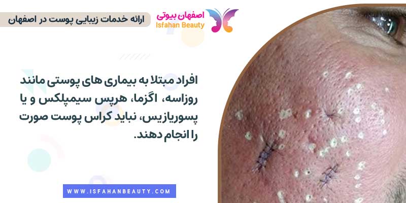 چه کسانی نباید کراس پوست صورت را انجام دهند؟