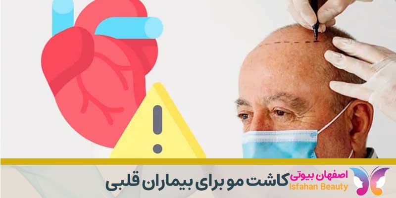 کاشت مو برای بیماران قلبی
