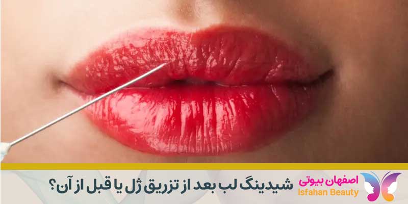 شیدینگ لب بعد از تزریق ژل یا قبل از آن؟
