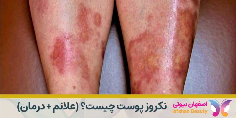 نکروز پوست چیست؟ (علائم + درمان)