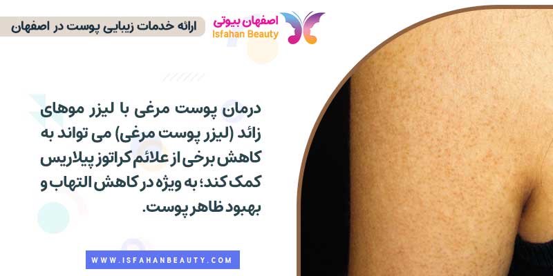 درمان پوست مرغی با لیزر موهای زائد در اصفهان