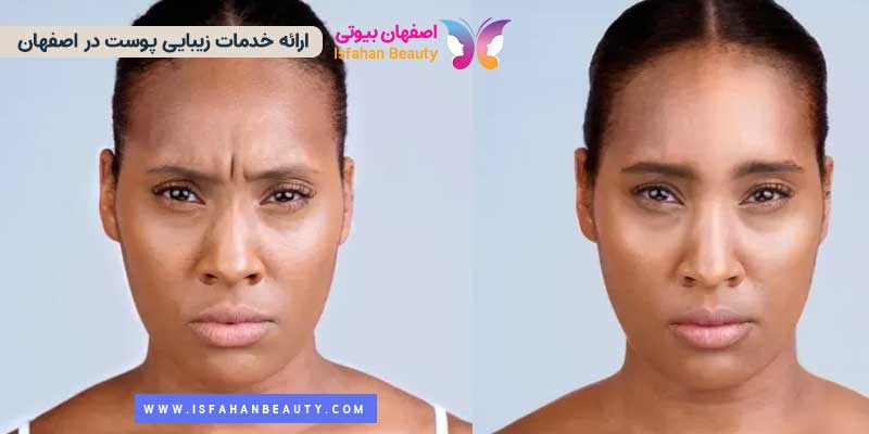 عکس قبل و بعد بوتاکس خط اخم