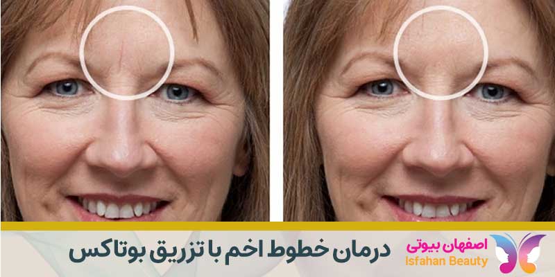 درمان خطوط اخم با تزریق بوتاکس | بوتاکس خط اخم