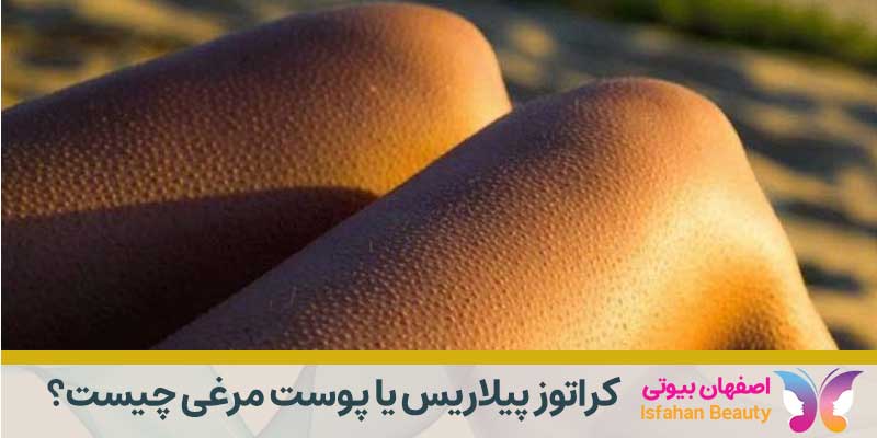 کراتوز پیلاریس یا پوست مرغی چیست؟
