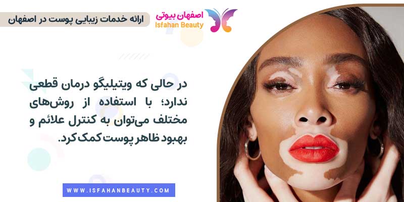 بیماری ویتیلیگو یا پیسی درمان دارد؟