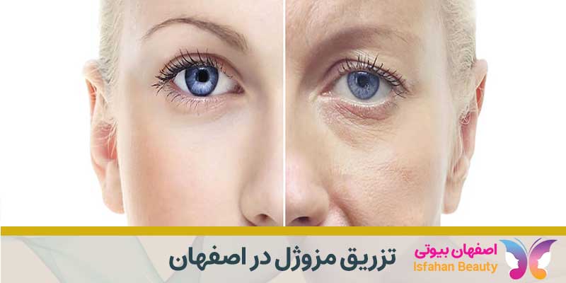 تزریق مزوژل در اصفهان
