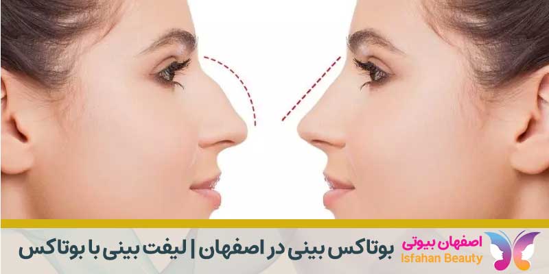 بوتاکس بینی در اصفهان | لیفت بینی با بوتاکس