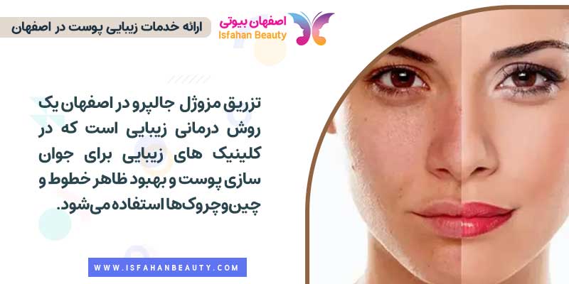 تزریق جالپرو در اصفهان
