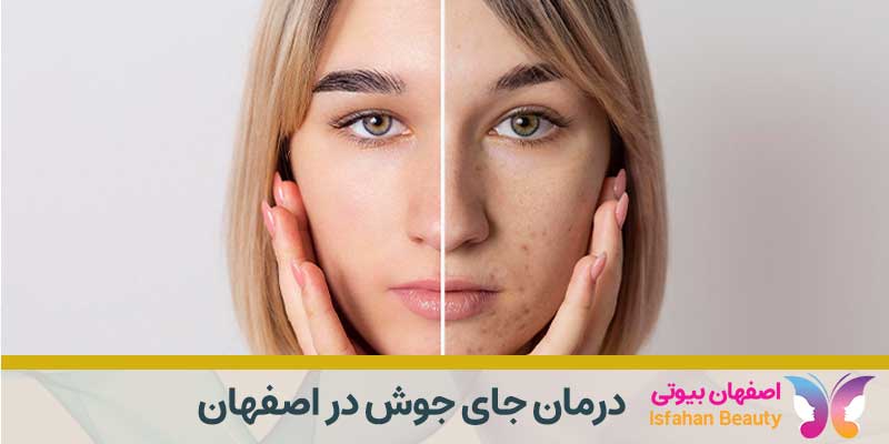 درمان جای جوش در اصفهان