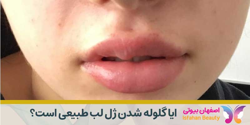 ایا گلوله شدن ژل لب طبیعی است؟