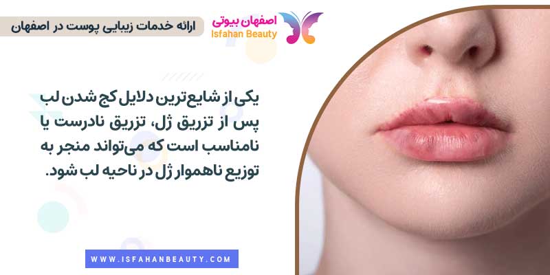 کج شدن لب بعد از تزریق ژل