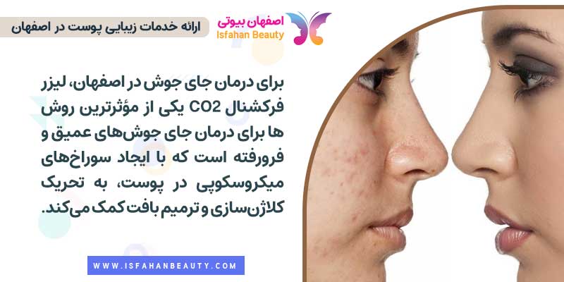 درمان جای جوش در اصفهان