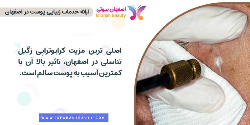 کرایوتراپی زگیل تناسلی اصفهان