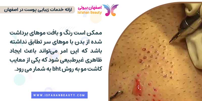 معایب کاشت مو به روش bht