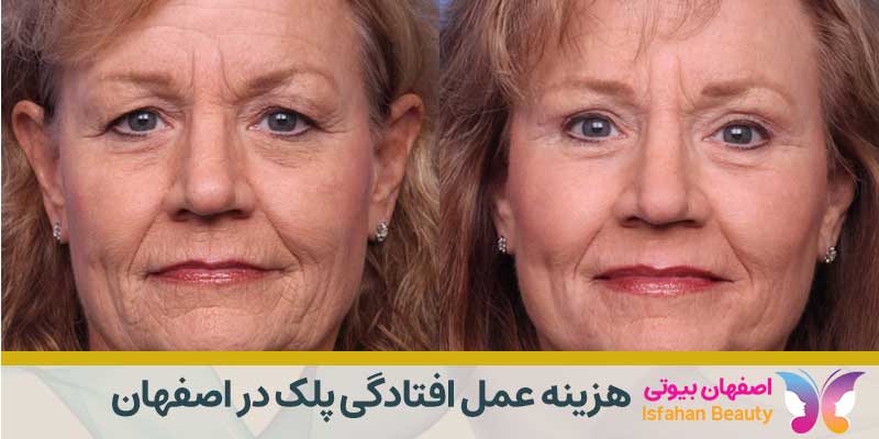 هزینه عمل افتادگی پلک در اصفهان