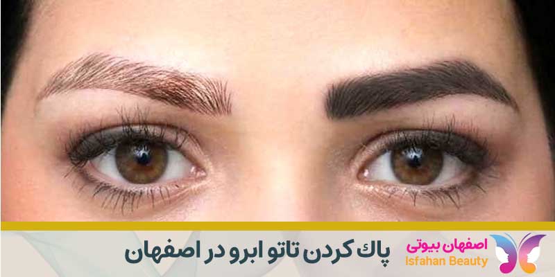 پاك كردن تاتو ابرو در اصفهان