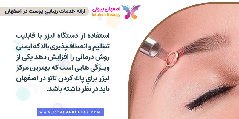 بهترين مركز ليزر براي پاك كردن تاتو در اصفهان