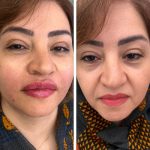 هایفوتراپی در اصفهان|کلینیک ساحل