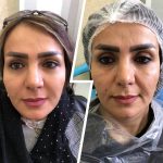 هایفوتراپی در اصفهان|کلینیک ساحل