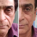 هایفوتراپی در اصفهان|کلینیک ساحل