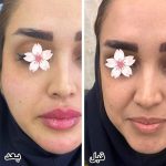 هایفوتراپی در اصفهان|کلینیک ساحل