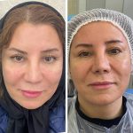 هایفوتراپی در اصفهان|کلینیک ساحل