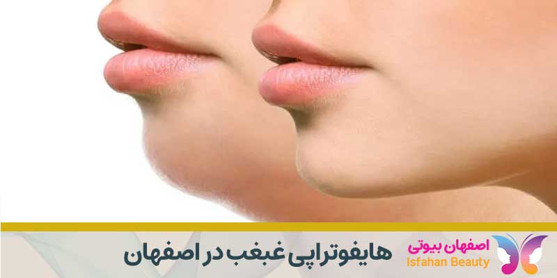 هایفوتراپی غبغب در اصفهان