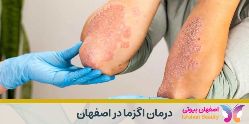 بهترین دکتر برای درمان اگزما در اصفهان