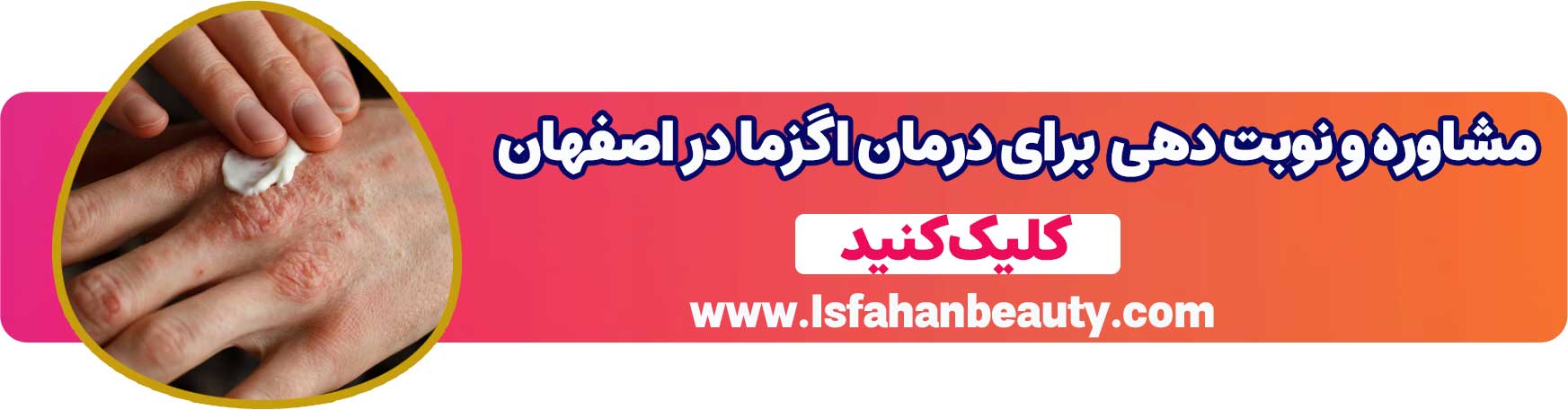 مشاوره و نوبت دهی برای درمان اگزما در اصفهان