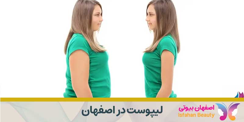 لیپوست در اصفهان