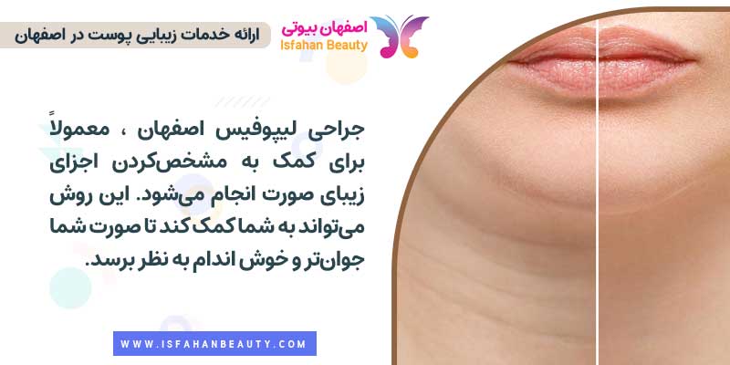 جراحی لیپوفیس اصفهان