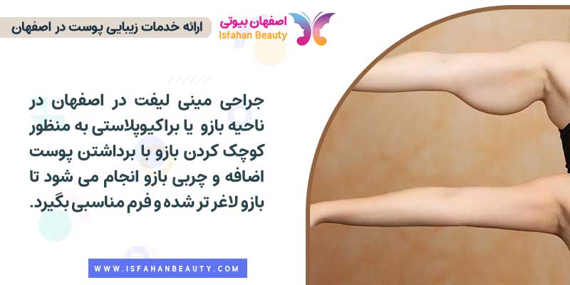 مینی لیفت اصفهان (جراحی مینی لیفت بازو)