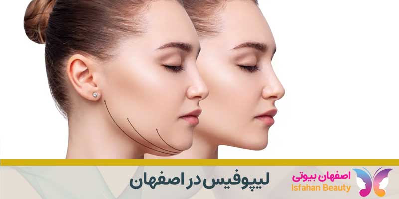 لیپوفیس در اصفهان
