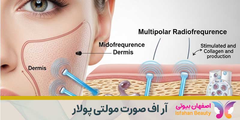 آر اف صورت مولتی پولار