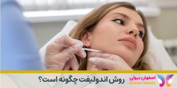 روش اندولیفت چگونه است؟