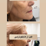 هایفوتراپی در اصفهان|دکتر شهرام آقاصالحه
