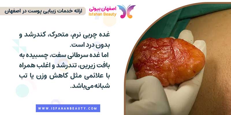 تفاوت غده چربی با غده سرطانی