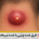 فرق غده چربی با غده سرطانی