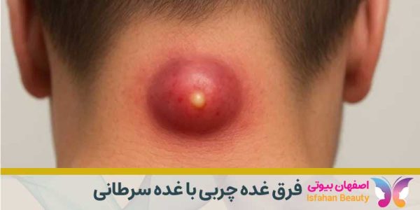 فرق غده چربی با غده سرطانی