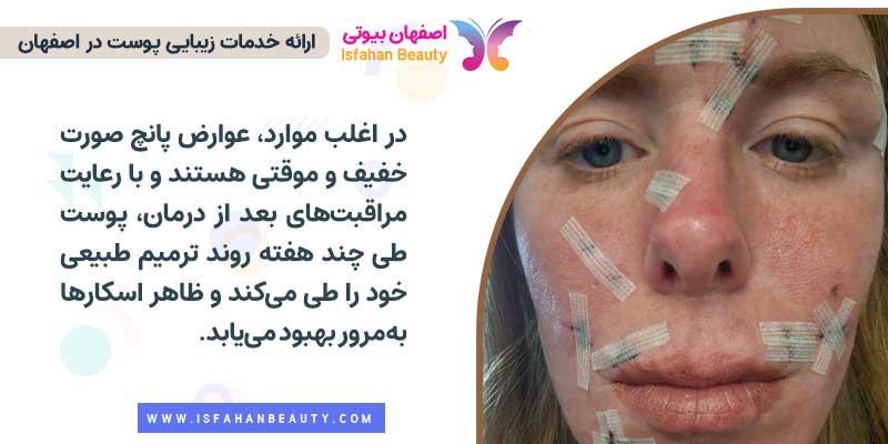 عوارض پانچ صورت